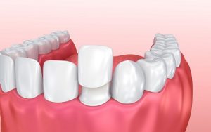 Cosmetic Composite Bonding or Porcelain Veneers Which Is Better 1