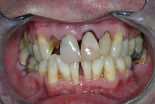 cp porcelain crowns before 1